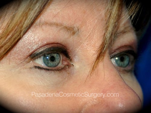 Eyelid Surgery Patient 16 After - 2