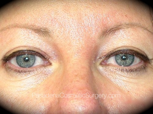Eyelid Surgery Patient 16 Before