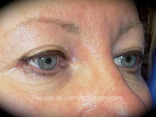 Eyelid Surgery Patient 16 Before - 2