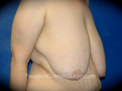 Breast Reduction Patient 04 Before - 2