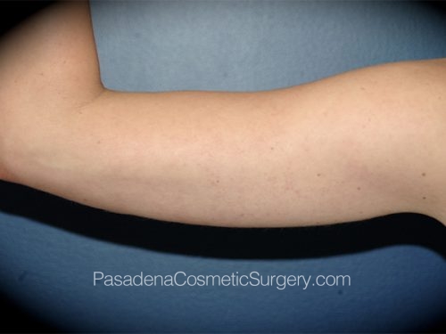 Arm Lift Patient 07 After - 2