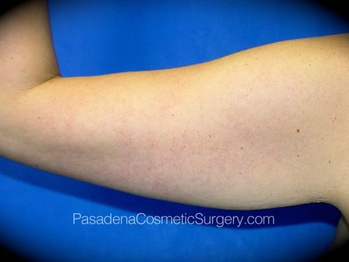 Arm Lift Patient 07 Before - 2