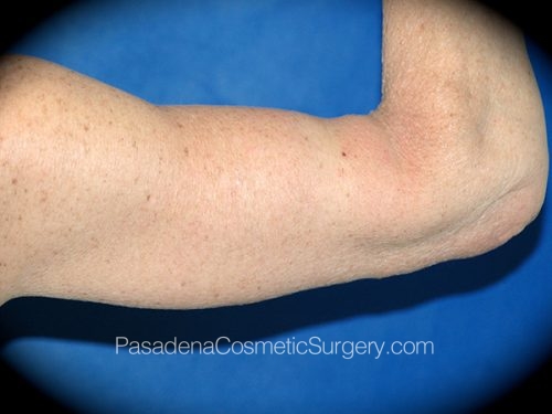 Arm Lift Patient 08 After - 2