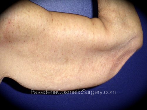 Arm Lift Patient 08 Before - 2