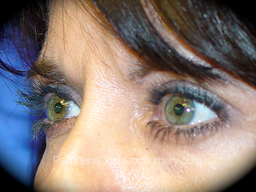 Eyelid Surgery Patient 17 After - 2