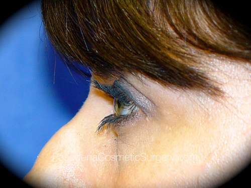 Eyelid Surgery Patient 17 After - 3