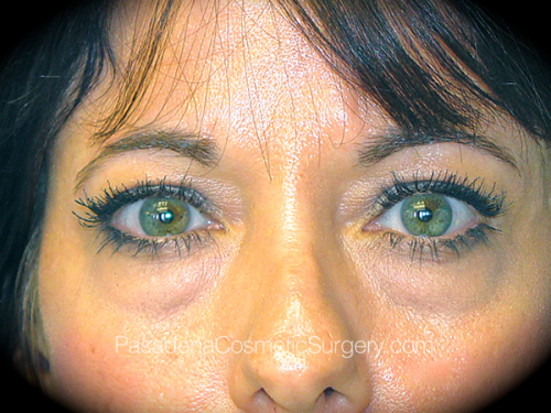 Eyelid Surgery Patient 17 Before