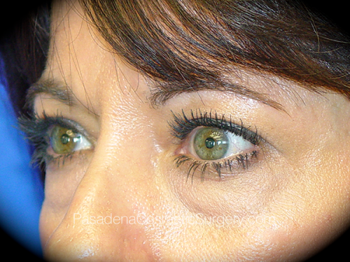 Eyelid Surgery Patient 17 Before - 2