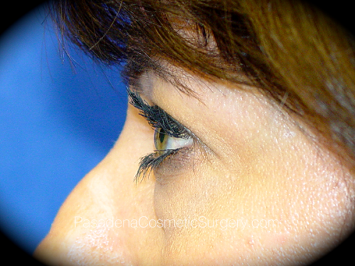 Eyelid Surgery Patient 17 Before - 3