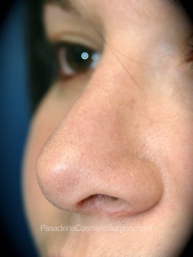 Rhinoplasty Patient 05 After