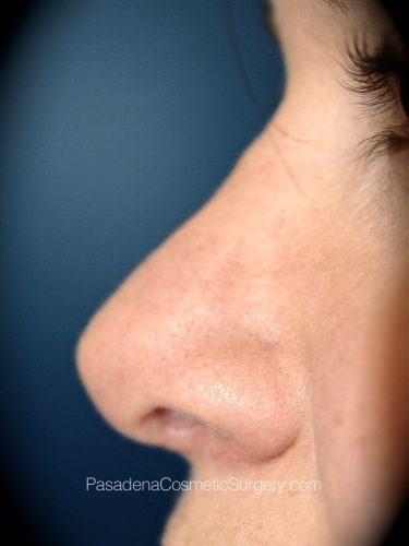 Rhinoplasty Patient 05 After - 2