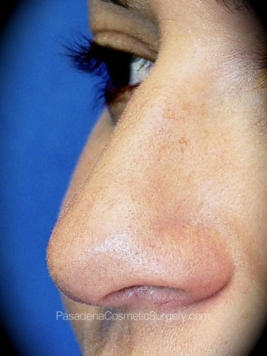 Rhinoplasty Patient 05 Before