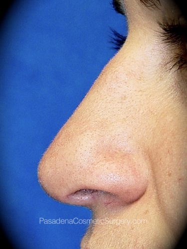 Rhinoplasty Patient 05 Before - 2