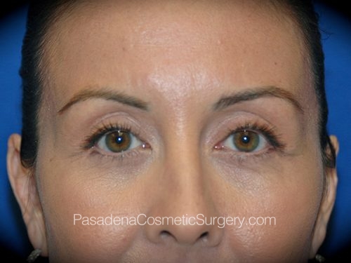 Eyelid Surgery Patient 05 After