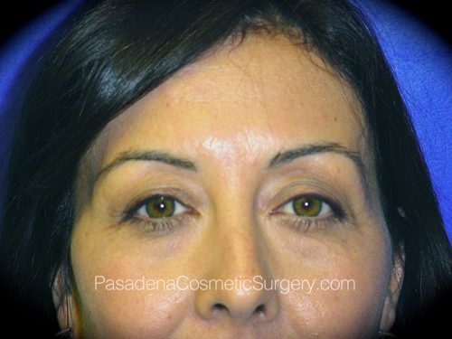 Eyelid Surgery Patient 05 Before