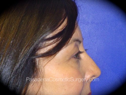 Eyelid Surgery Patient 05 Before - 3