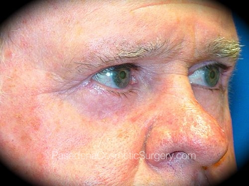 Eyelid Surgery Patient 06 After - 2