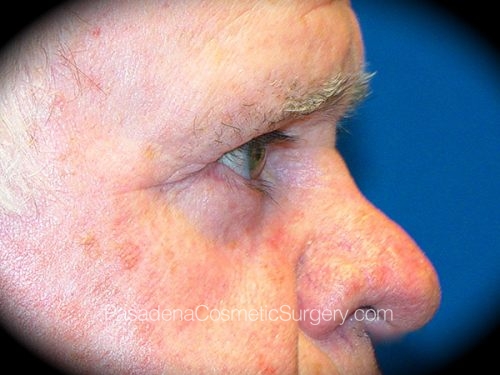 Eyelid Surgery Patient 06 After - 3