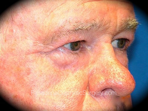 Eyelid Surgery Patient 06 Before - 2