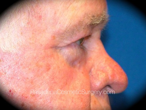 Eyelid Surgery Patient 06 Before - 3