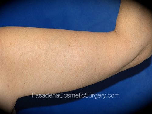 Arm Lift Patient 09 After - 2