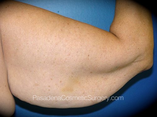 Arm Lift Patient 09 Before - 2