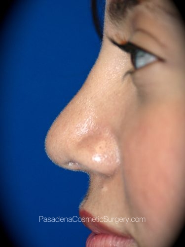 Rhinoplasty Patient 06 After - 2