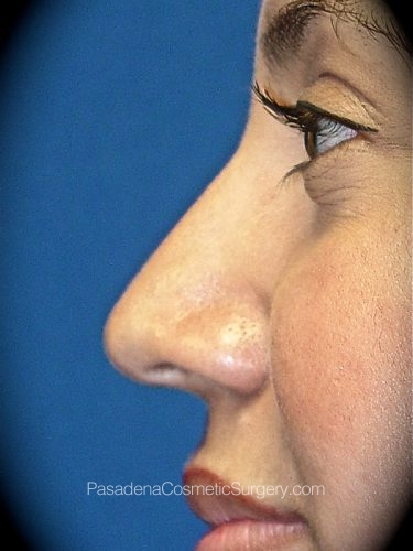 Rhinoplasty Patient 06 Before - 2
