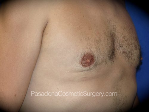 Gynecomastia Patient 03 After - 2