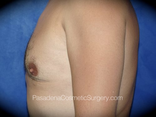 Gynecomastia Patient 03 After - 3