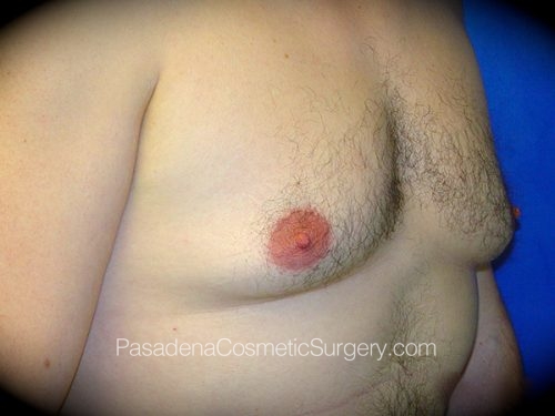 Gynecomastia Patient 03 Before - 2