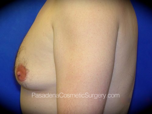 Gynecomastia Patient 03 Before - 3