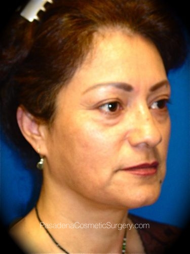 Facelift Patient 03 Before - 2