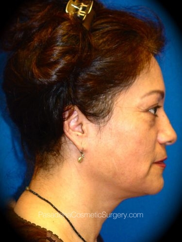 Facelift Patient 03 Before - 3