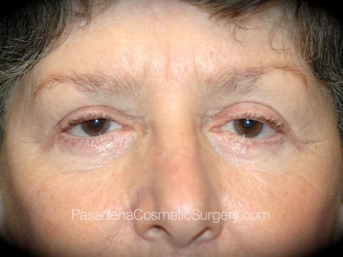 Eyelid Surgery Patient 18 After