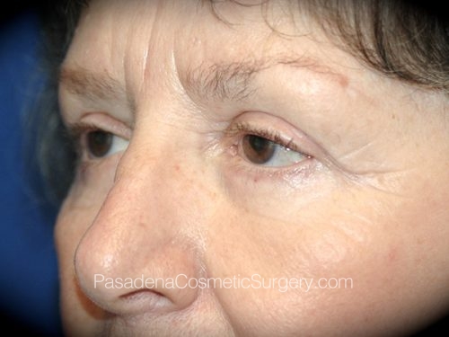Eyelid Surgery Patient 18 After - 2