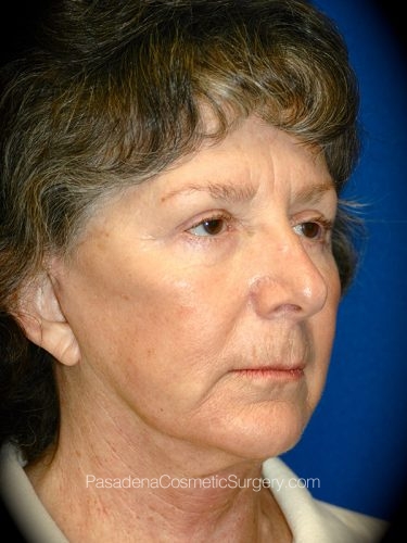Facelift Patient 10 After - 3
