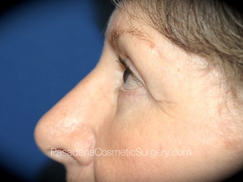Eyelid Surgery Patient 18 After - 3