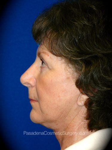 Facelift Patient 10 After - 2