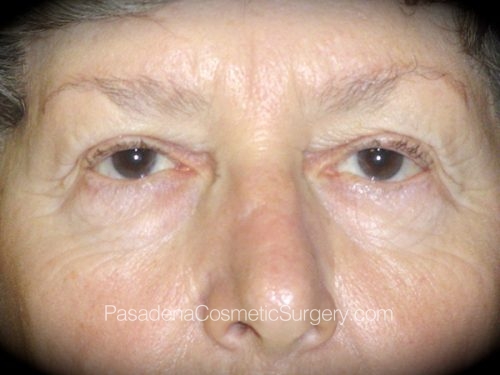 Eyelid Surgery Patient 18 Before