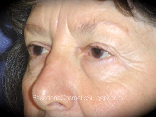 Eyelid Surgery Patient 18 Before - 2