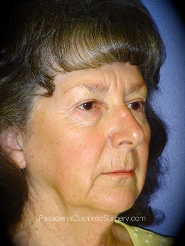 Facelift Patient 10 Before - 3