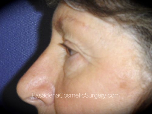 Eyelid Surgery Patient 18 Before - 3