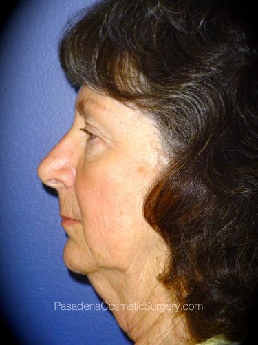 Facelift Patient 10 Before - 2