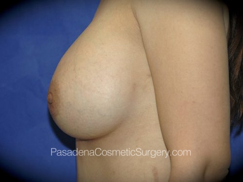 Breast Augmentation Patient 17 After - 3