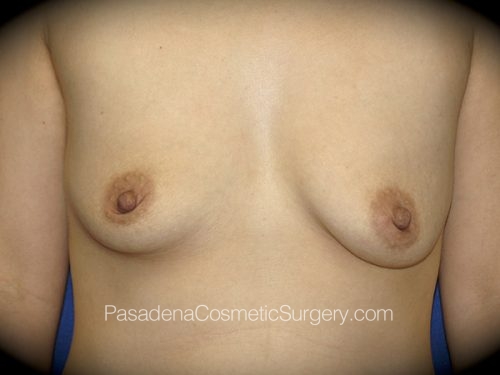 Breast Augmentation Patient 17 Before