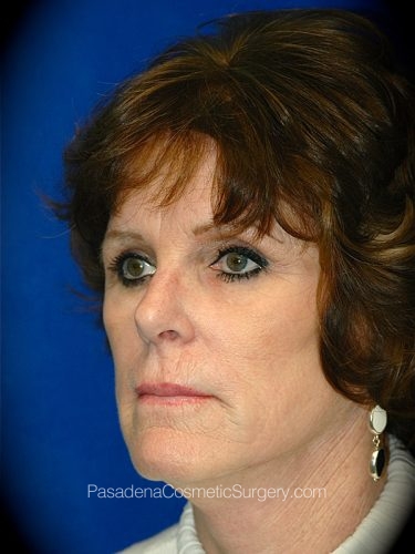 Facelift Patient 11 After - 3