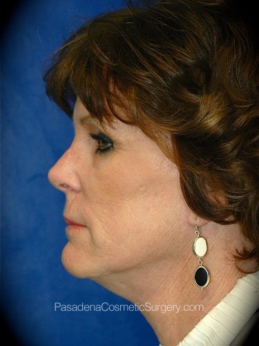 Facelift Patient 11 After - 2