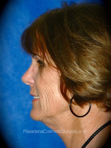 Facelift Patient 11 Before - 2