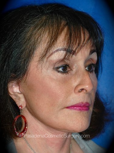 Facelift Patient 12 After - 3